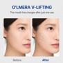 O'LMERA V-LIFTING DEVICE (1 pair)